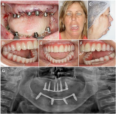 A Implants Placed Immediately After Teeth Extraction Frontal Aspect Download Scientific