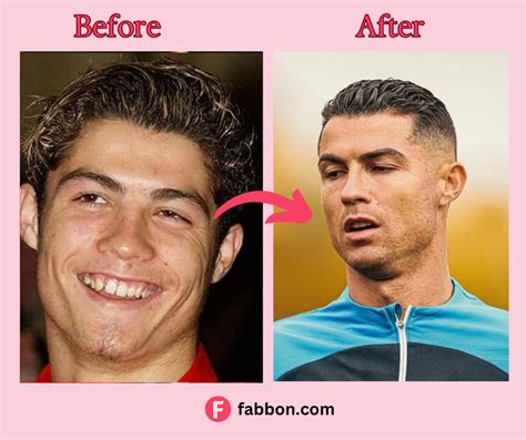 Did Cristiano Ronaldo Have Plastic Surgery? Doctors Say Yes! | Fabbon