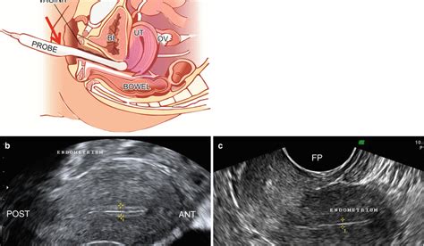 The Use Of Color Doppler Ultrasound With Transvaginal Probe