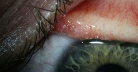 Doctors Remove 14 Worms From Oregon Woman's Eye | HuffPost UK