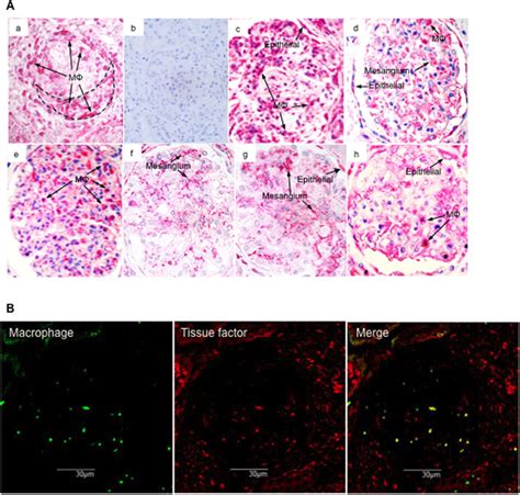 Glomerular Tissue Factor Expression In Biopsy Tissues A