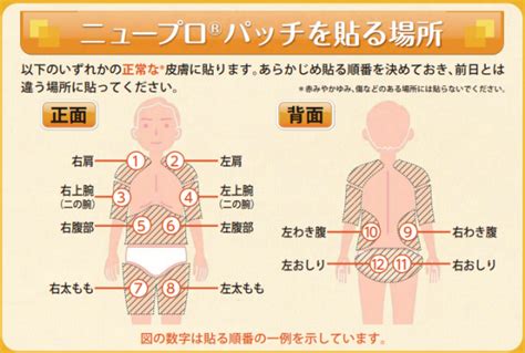 ニュープロパッチはパーキンソン病治療に使用する貼り薬