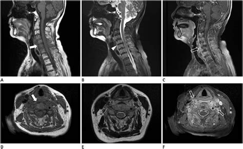 Abnormal Cervical Spine Mri