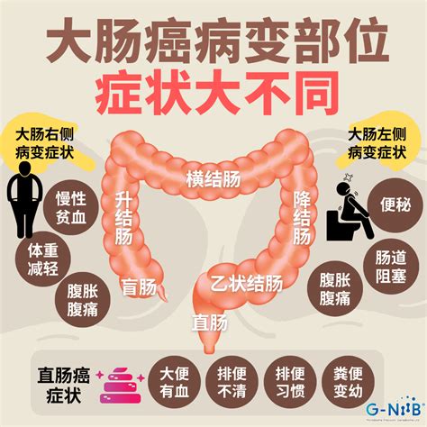 大肠癌病变部位 症状大不同 Geniebiome Limited 用科研重建健康微生态