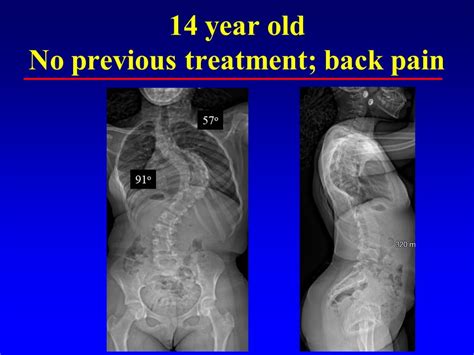 Severe Idiopathic Scoliosis Treated With Preoperative Halo Gravity