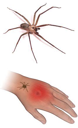 Spider Bites Johns Hopkins Medicine Spider Bites Brown Recluse