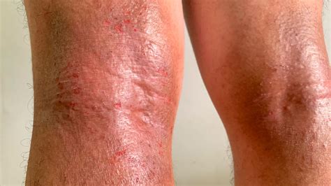 Eczema On Elbows