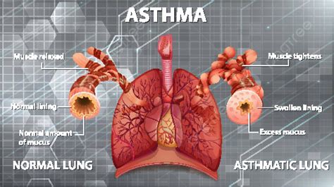 Asthma Lungs Compared To Normal Lungs