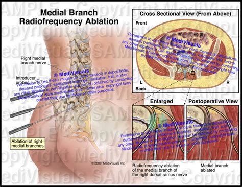 Radiofrequency Ablation Rfa What It Is Procedure 49 Off