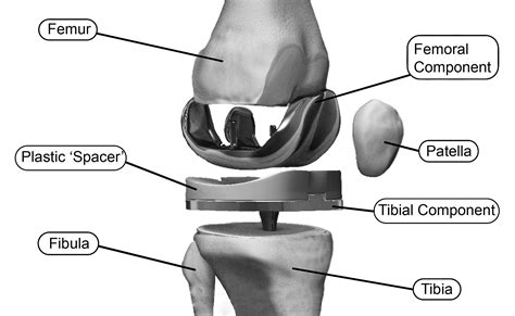 Mechanical Joint Implant Images Hip And Knee Handbook Of Joint