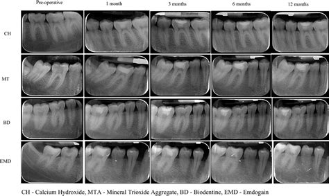 Pre Operative And Follow Up Radiographs Ch Calcium Hydroxide Mta