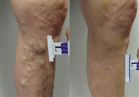 Before And After Texas Vein And Wellness Institute