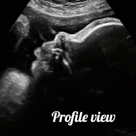 Normal 34 Week Pregnancy And Ultrasound Your Complete Guide