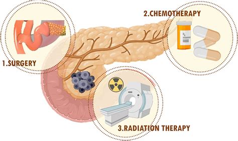 Conventional Treatment Approaches For Pancreatic Cancer Download Scientific Diagram