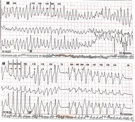 24 Hour Ecg Holter 24 Hour Holter Monitor Records Of Torsade De Download Scientific Diagram