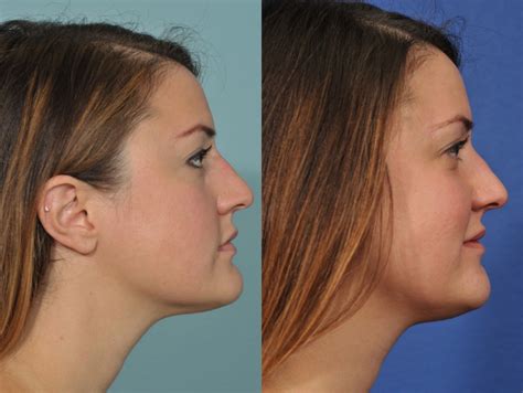 Rhinoplasty Before And After 1 Jesse E Smith Md Facs Ft Worth