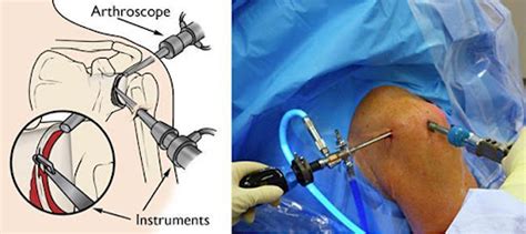 Knee Arthroscopy : Dr. Varun Aggarwal