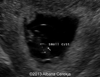 📃 Umbilical cord cysts, 2 cases