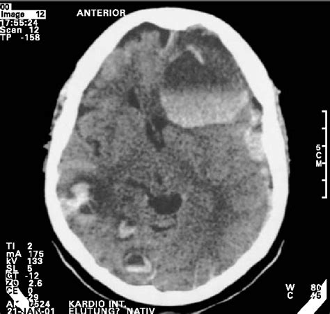 Figure 1 From Cerebral Vasculitis With Multiple Infarcts Caused By Lyme