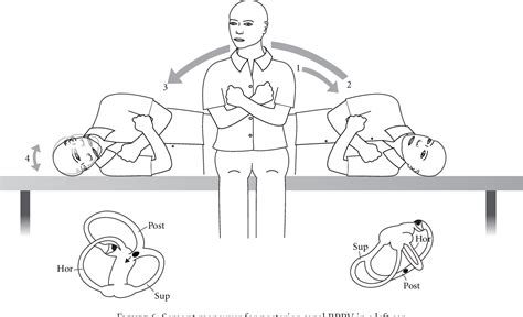 Figure 4 From Benign Paroxysmal Positional Vertigo Bppv History Pathophysiology Office