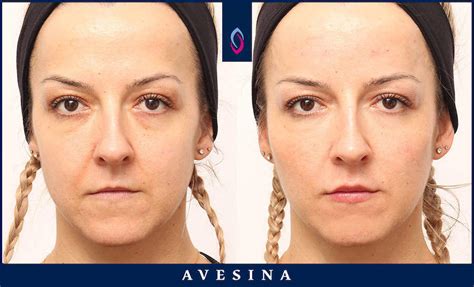 Faltenbehandlungen mit Botox in Köln bei Avesina