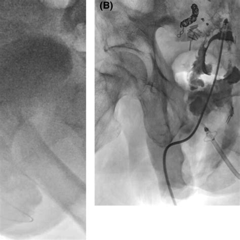 Percutaneous drainage toward the pelvic abscess. A 14Fr Malecot drain ...