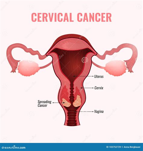 Cervical Cancer Image Stock Vector Illustration Of Body 103752729