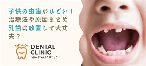 子供の虫歯がひどくて落ち込む。治療法や原因まとめ｜ノイローゼにならなくても大丈夫！