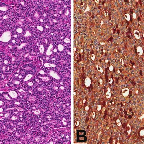 A H E Stained Slide From Patient With Ductal Like Growth Of