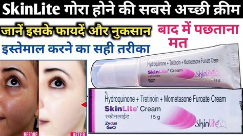 Skinlite Cream Skinlite Cream Review In Hindi