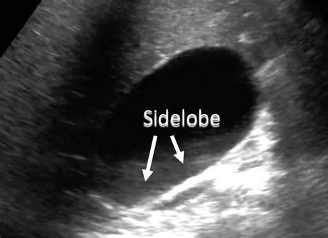 Artifacts In Ultrasound Sidelobe