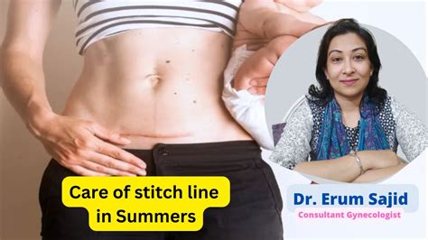 Care Of Stitch Line In Summers Dr Erum Hassan Clinic Best Gynaecologist