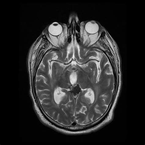 Solitary Fibrous Tumor Hemangiopericytoma Image Radiopaedia Org