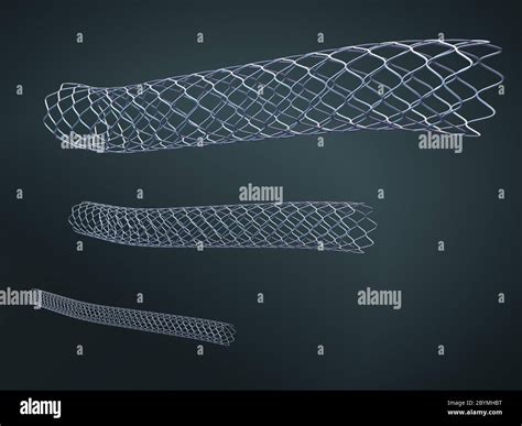 Three Metal Stents For Implantation And Supporting Blood Circulation