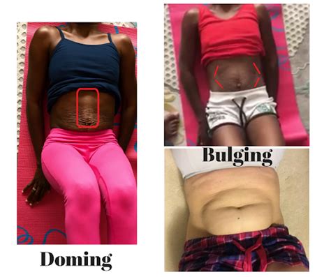 Diastasis Recti Symptoms Core Fitness For Moms