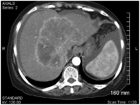 Intrahepatic Cholangiocarcinoma Icc Detected By Sonography Breianon