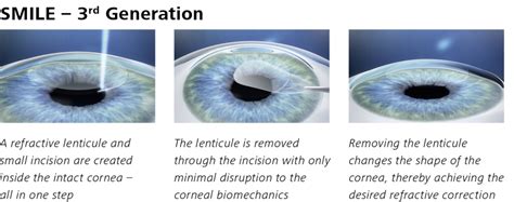 Recovery After Laser Eye Surgery - We Fix Eyes