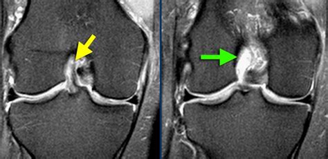 Un Genunchi Cu Ligamentul Ncruci At Anterior Rupt Va Suferi De Artroz