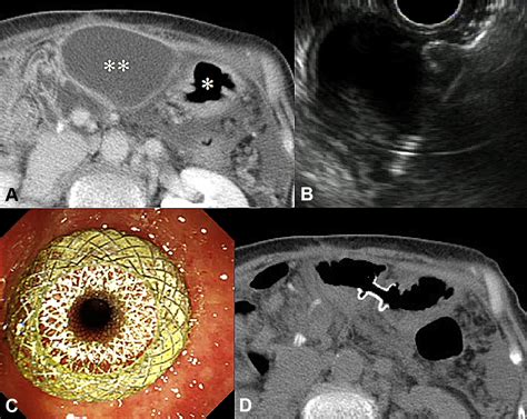 One Step Eus Guided Gastrojejunostomy With Use Of Lumen Apposing Metal Stent For Afferent Loop