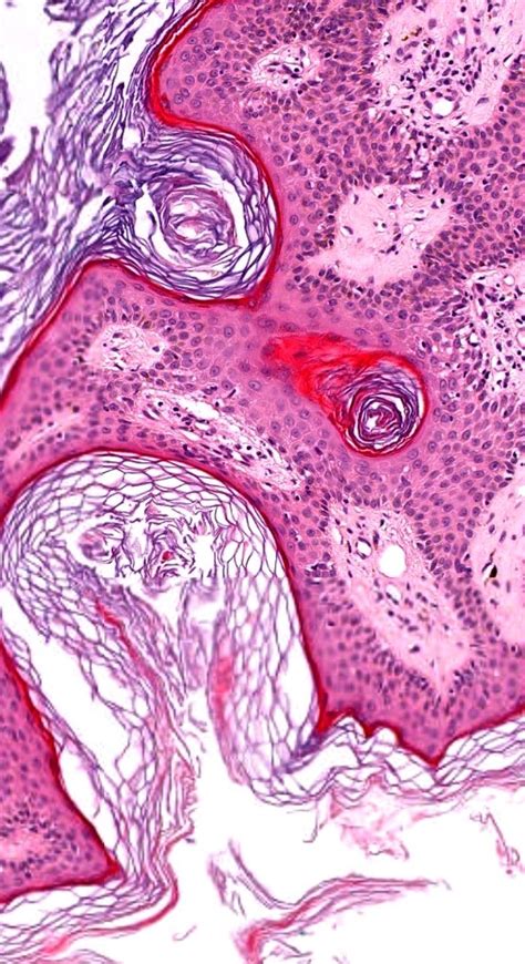 Pin On Dermatopathology Quiz Cases