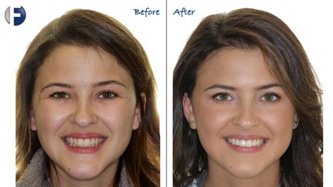 How A Herbst Device Can Help Your Smile Frey Orthodontics