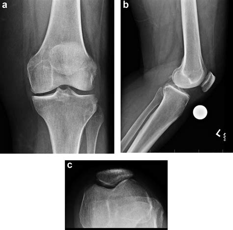 Flexion Contracture Due To Cyclops Lesion After Bicruciate Retaining