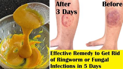 In 5 Days Get Rid Of Ringworm And Any Fungal Infections Effective Home Remedy To Cure Ringworm