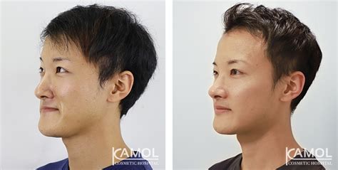 Corrective Jaw Surgery