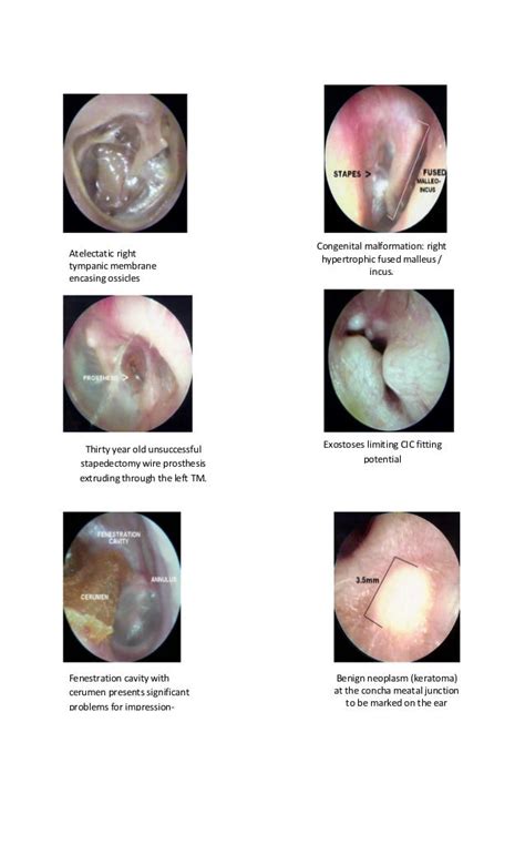 Tympanic Membrane Dr Fadil