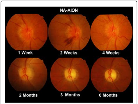 Progression of Optic Nerve changes in NA-AION from initial hyperaemia... | Download Scientific ...