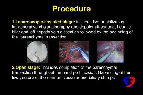 Ppt Laparoscopic Assisted Donor Hepatectomy Is It Possible Is It