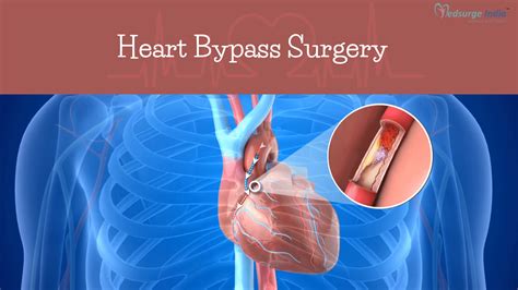 Heart Bypass Surgery Cost In Chennai Heart Surgery Medsurge India