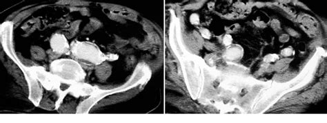 Figure From Endovascular Exclusion Of Symptomatic Bilateral Common