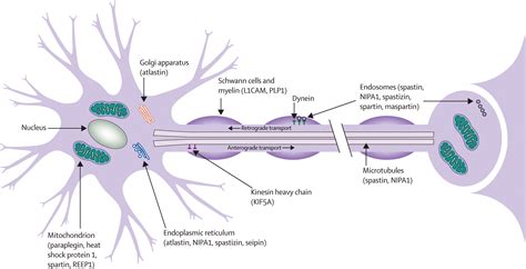 Hereditary Spastic Paraplegia Clinical Features And Pathogenetic